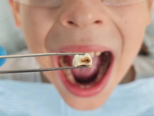 Best Emergency Dentist for Lost Fillings or Crowns in Point Roberts, WA